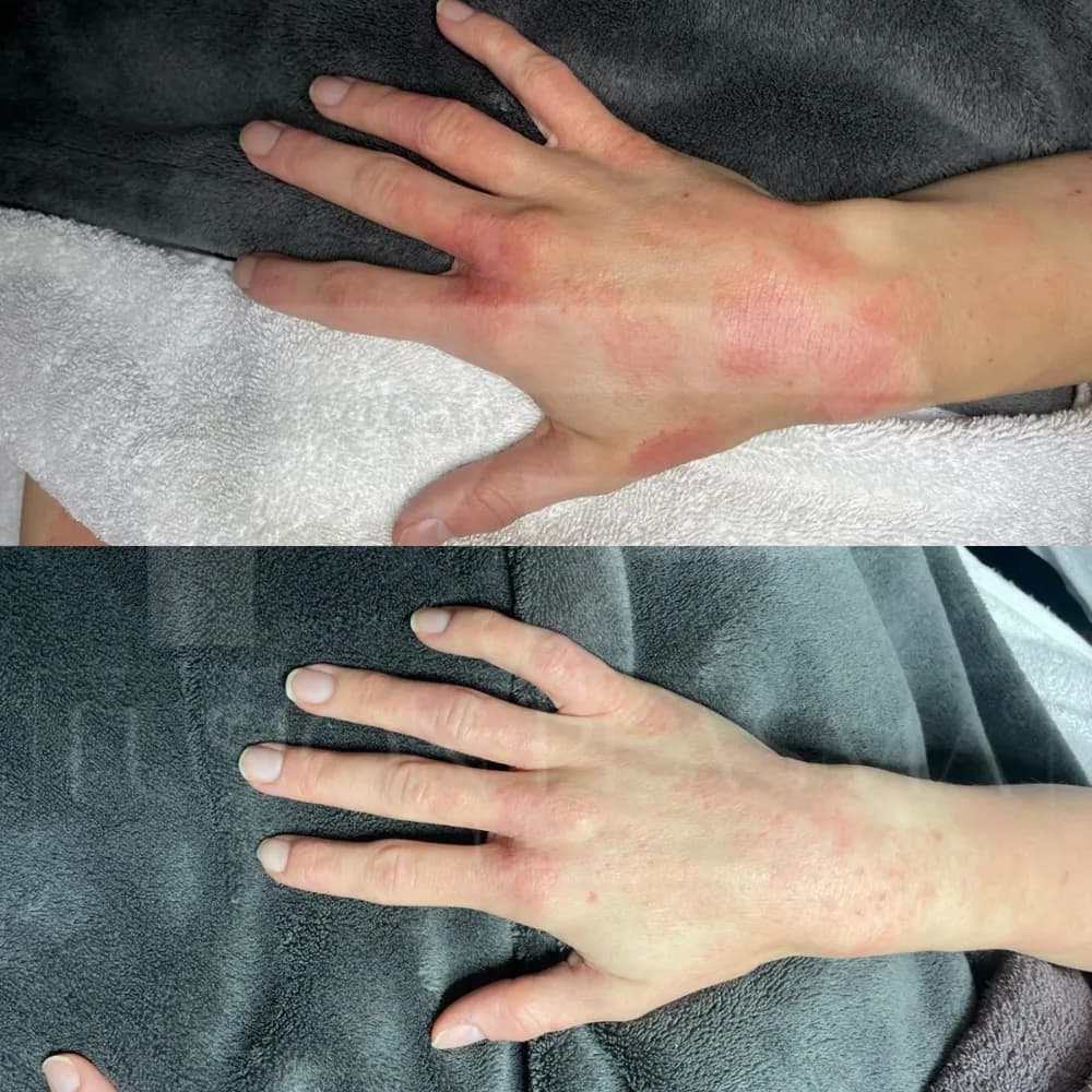 Fusion Plasma, avant et après : taches pigmentaires sur le dos de la main