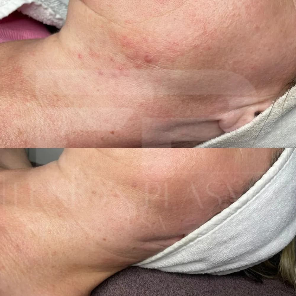 Fusion Plasma, avant et après : texture de la peau du bras