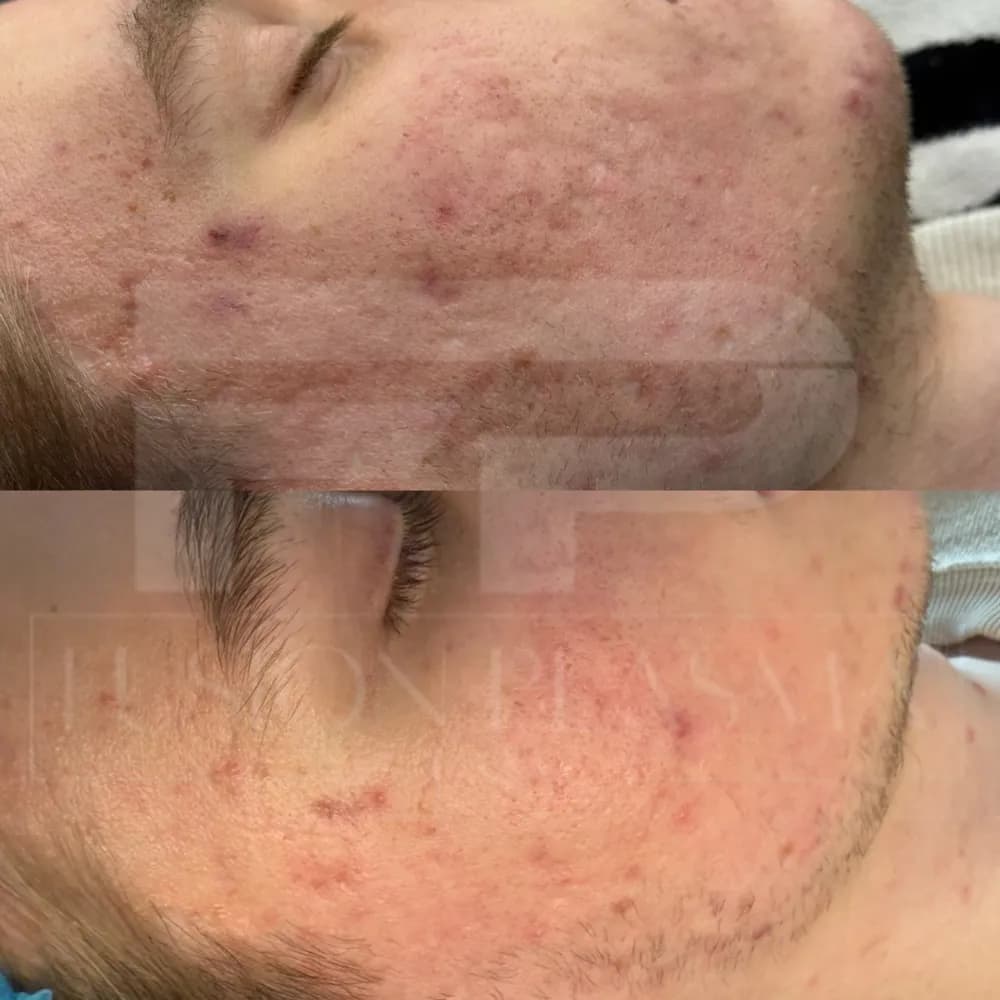 Fusion Plasma, avant et après : texture du cou et du menton